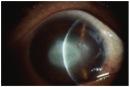 Acanthamoeba keratitis.jpg