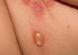 Blærer i huden.Bulløs impetigo