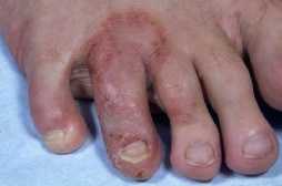 Fodeksem [Eczema mikrobialis]