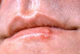 Forkølelsessår (herpes labialis)