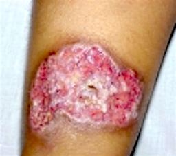Sårdannelser (pyoderma gangrænosum)