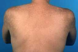 Svamp i huden [pityriasis versicolor]