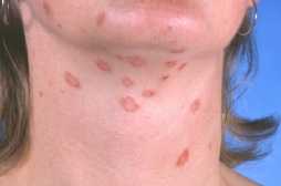 Svampeinfektion [Dermatophytosis.Tinea]