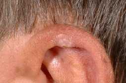 Tryksår på øret [chondrodermatitis nodularis helicis auris]