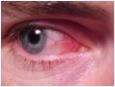 allergisk konjuktivitis.jpg