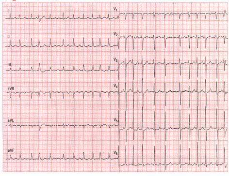 ekg_ny_Atrieflimren