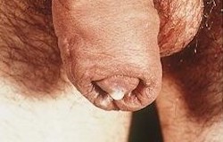 Gonoré, seksuel infektion