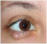 Haglkorn [Chalazion]