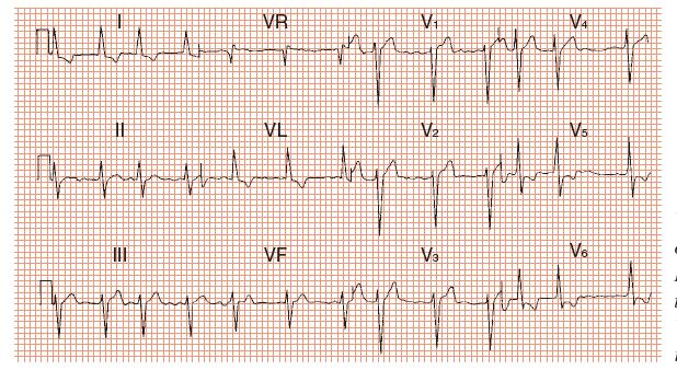 Venstresidig hypertrofi 