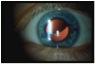 linse luxation ved Marfan Syndrom