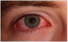 rødt øje ved konjunktivitis.jpg