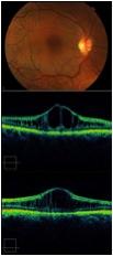 Cystoid maculaødem (CME).jpg