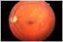 Diabetisk retinopathi.jpg