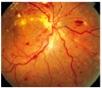 Nethindens_sygdomme._Fundus_hypertonicus._FH3.jpg