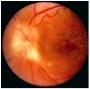 Nethindens sygdomme. Fundus hypertonicus. FH4.jpg