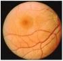 Nethindens_sygdomme._Fundus_hypertonicus, fh2.jpg