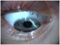 abrasio cornea.jpg