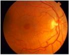 Foramen macula .jpg