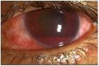 hyphema, blod i øjets forreste kammer.jpg