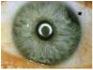 iridodialyse, stump trauma.jpg