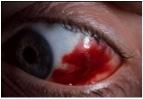 subconjunktival blødning.jpg