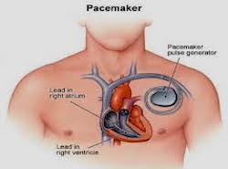 pacemakeren