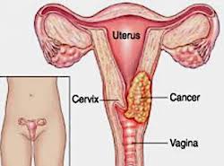 HPV - Human papillomavirus