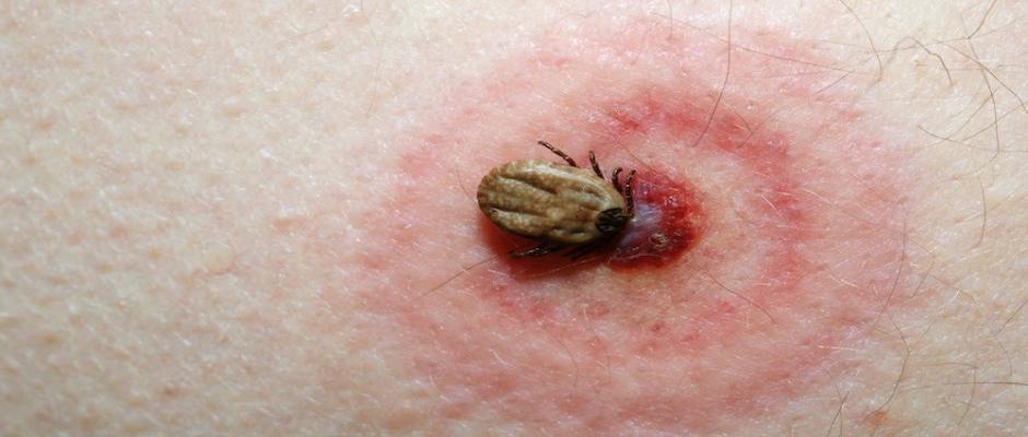 Borreliose [Skovflåtbid]