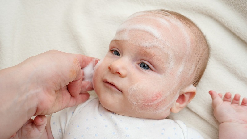 dermatitis
